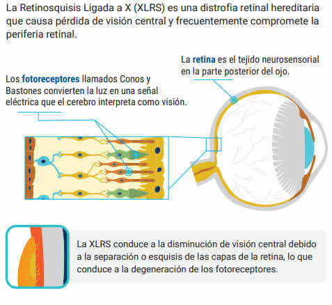 Retinosquísis Ligada a X (RS1)